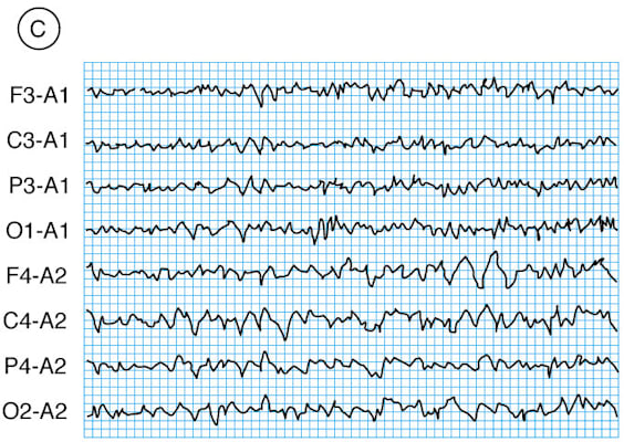 Gehirn: EEG