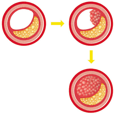 Blutkreislauf: Stadien einer Arteriosklerose II (Grafik)