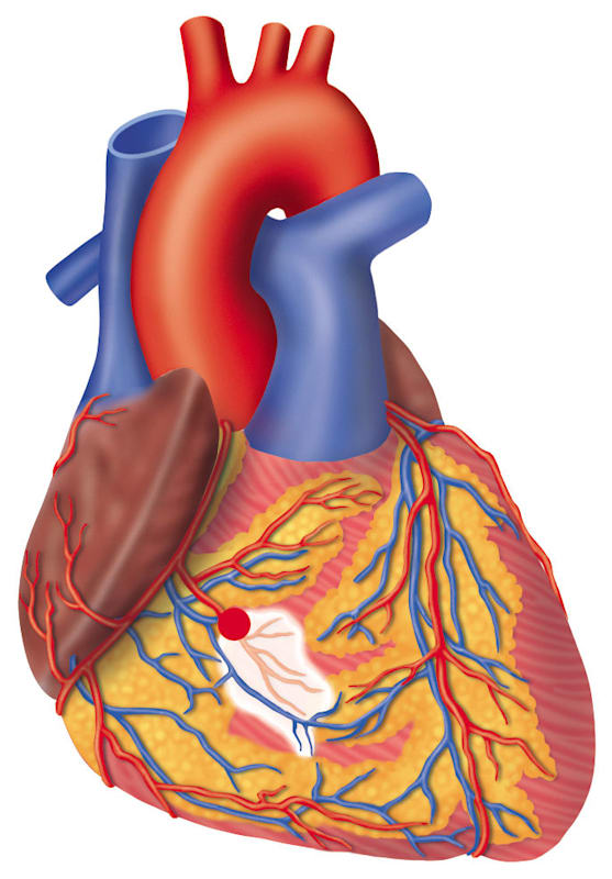 Blutkreislauf: Herzinfarkt (Grafik)