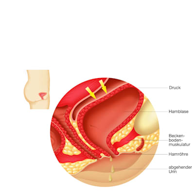 Blase: Harninkontinenz (Grafik)