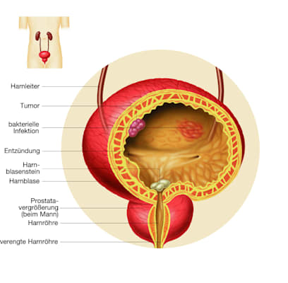 Blase: Erkrankungen (Grafik)