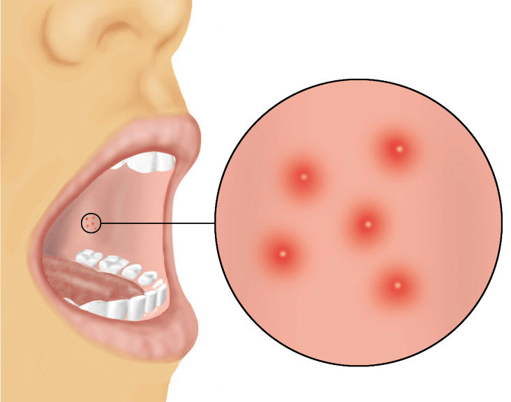 Masern: Koplik-Flecken