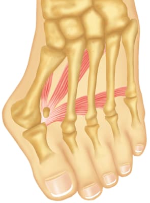 Knochen: Hallux valgus (schematische Darstellung)