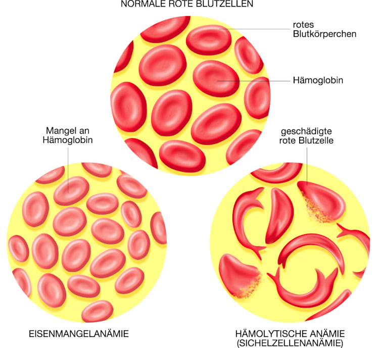 Blut: Formen der Anämie (Grafik)