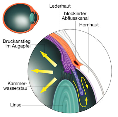 Auge: Glaukom