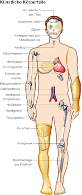 Medizintechnik: Implantate