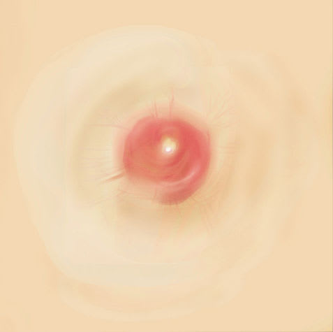 Geschlechtsorgane: Mastitis (Detailgrafik)