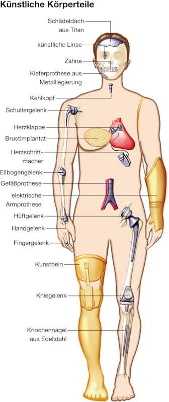 Medizintechnik: Implantate