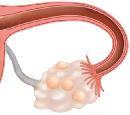 Geschlechtsorgane: polyzystischer Eierstock (Detailgrafik)