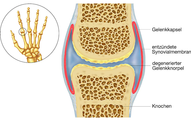 Arthritis (chronische Polyarthritis)