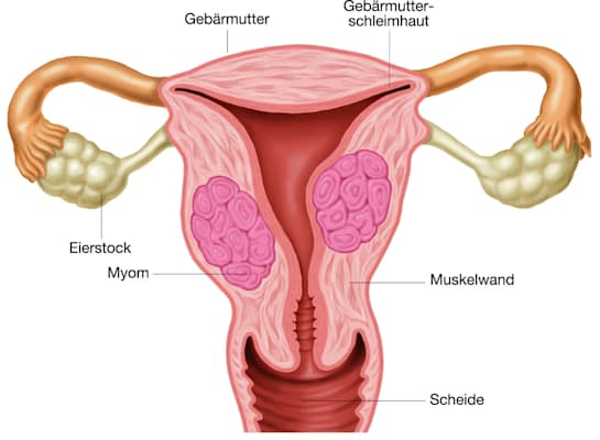 Gebärmuttermyom (Grafik)