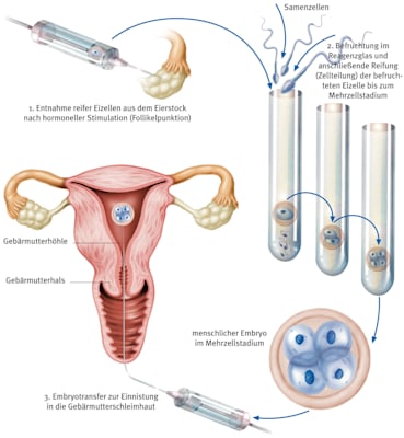 In-Vitro-Fertilisation