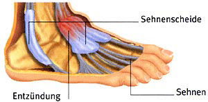 Sehnenscheidenentzündung