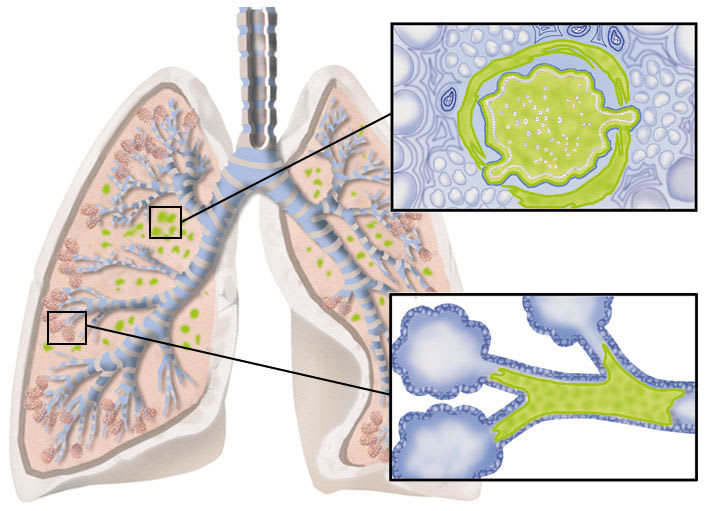 Lunge: Mukoviszidose