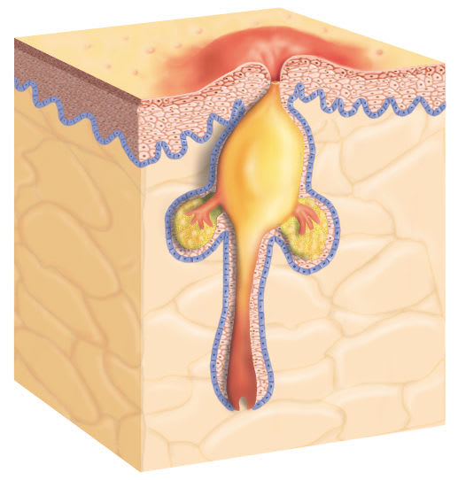 Akne: Verstopfte Talgdrüse