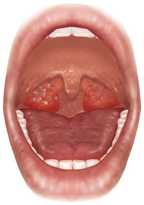 Mandelentzündung