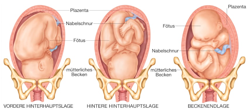 Lagen des Fötus vor der Geburt (Grafik)