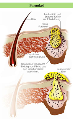 Furunkel (Grafik)