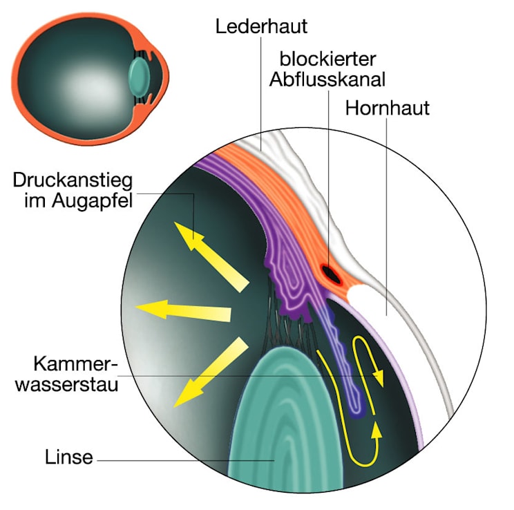 Auge: Glaukom