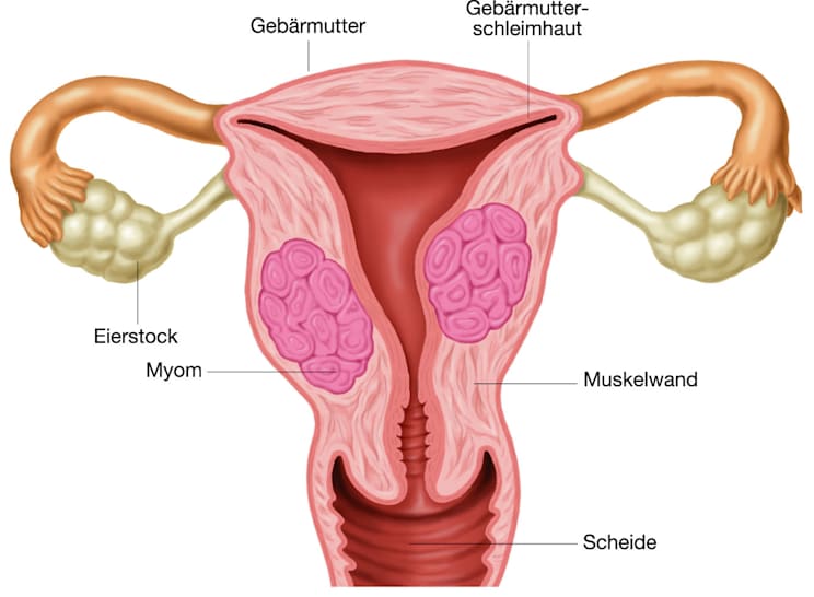 Gebärmuttermyom (Grafik)