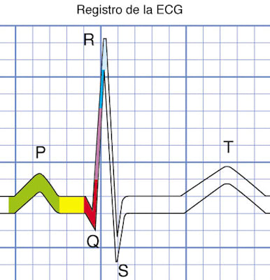 Blutkreislauf: Herzautorhythmie im EKG (Grafik)