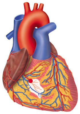 Blutkreislauf: Herzinfarkt (Grafik)
