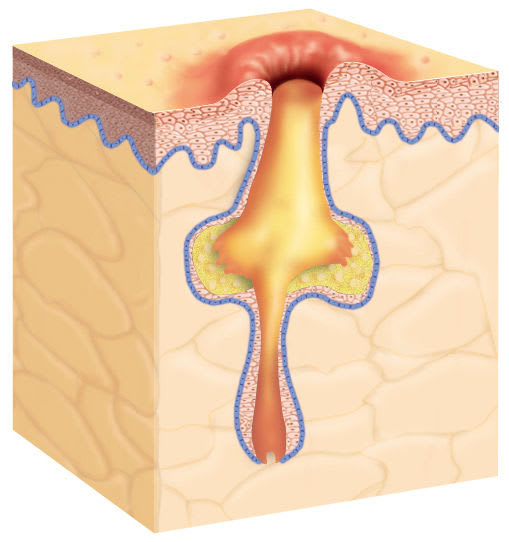 Akne: Entzündeter Haarbalg